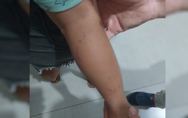 Mordida na perna da criança