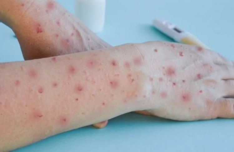 OMS avalia declarar varíola dos macacos como 'emergência global'