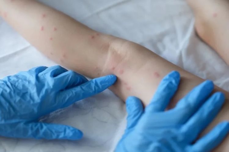 Varíola dos macacos: Sesapi reforça vigilância; Piauí tem 2 casos suspeitos (Foto: Reprodução/ Píxabay)