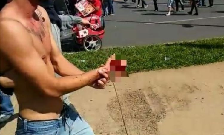 Manifestante não teve o nome revelado, mas a mão ficou dilacerada. Fonte: Jornal de Brasília